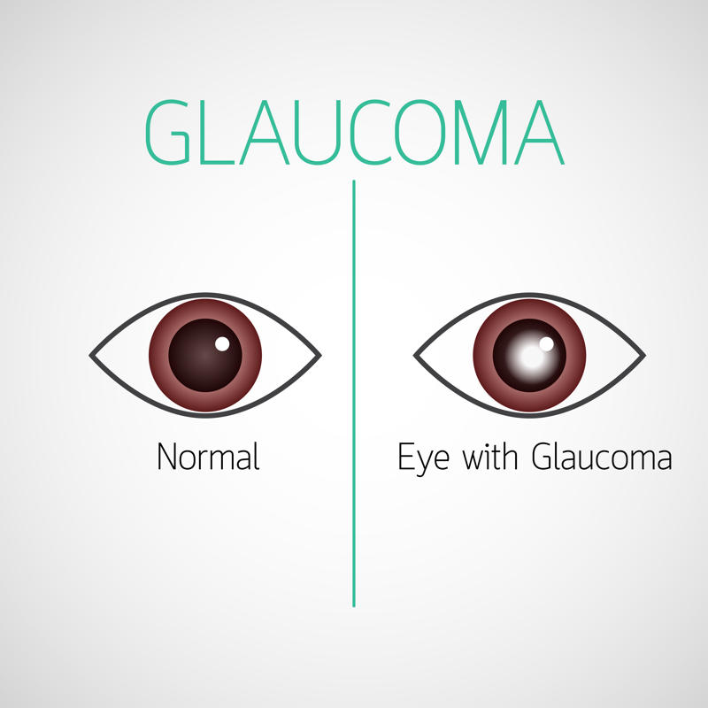 glaucoma occhio